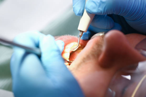 Best Emergency Tooth Extraction in Grove City, OH